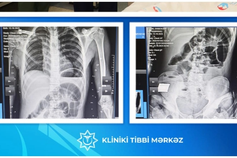 Yeniyetmənin bağırsağından taxta çıxarılıb