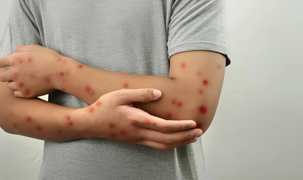 Alimlər meymunçiçəyi virusunun yeni&nbsp;dalğasını aşkarladılar