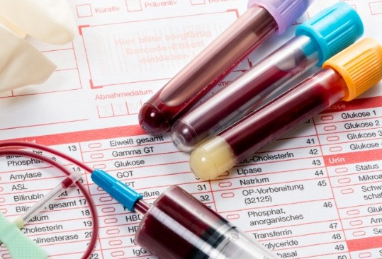 İki qan analizi arasında fərq ciddi risk yarada bilər - ARAŞDIRMA