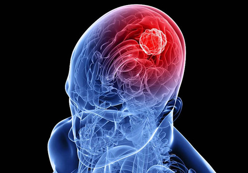 Yeni kəşf: Beyin xərçəngi şiş yaranmazdan əvvəl başlayır