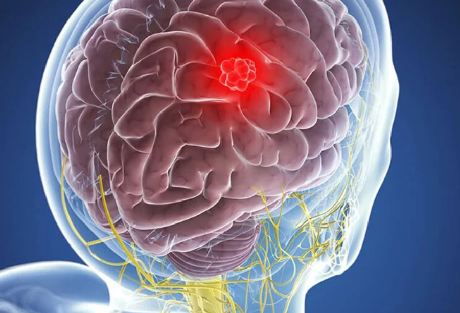 Beyin şişlərinə qarşı inqilabi kəşf