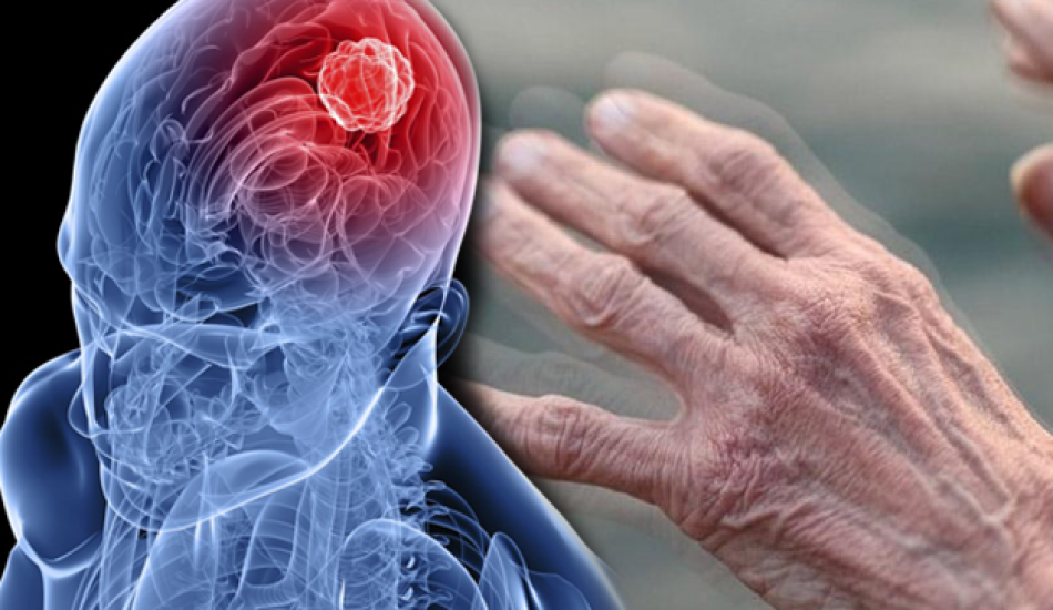 Parkinson xəstəliyinin müalicəsində mühüm kəşf